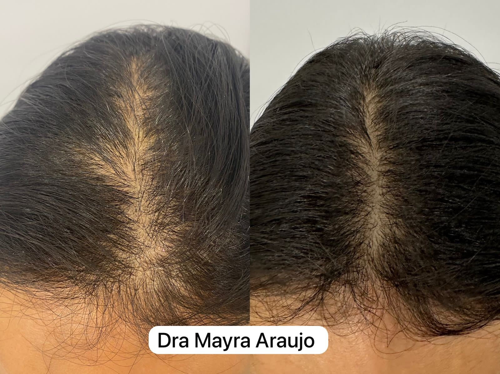 Aparelho de endolaser sendo utilizado